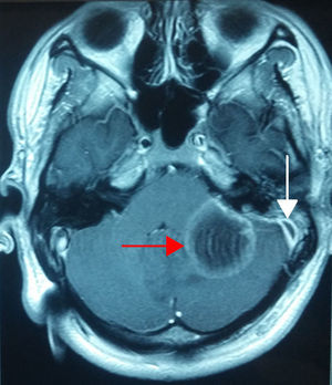 Nuclear magnetic resonance of the skull, axial plane in T1 gadolinium sequence; showing the cerebellar abscess (red arrow) and the swollen meninx at the level of the left sigmoid sinus (white arrow).
