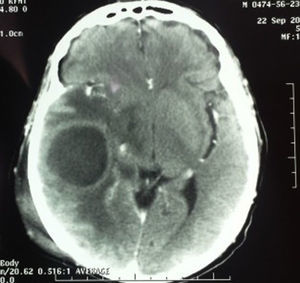 Contrasted computed tomography of the skull; showing brain abscess with perilesional oedema and soft tissue oedema.