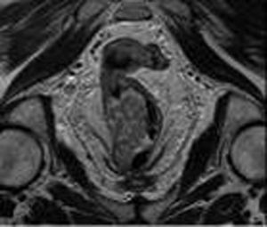 Magnetic nuclear resonance showing a lesion in the lower rectum on the right lateral side, infiltrating the most cranial fibres of the internal sphincter, with a suspicious mesorectal lymph node.