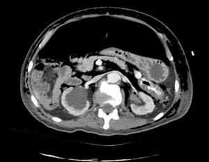 Axial slice abdominal computed tomography: major pneumoperitoneum and bilateral subcutaneous emphysema.
