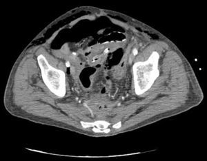 Axial slice abdominopelvic computed tomography: pneumoperitoneum and bilateral subcutaneous emphysema.