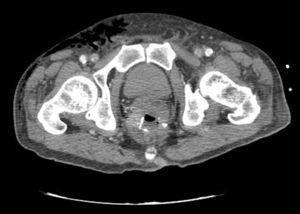 Axial slice pelvic computed tomography: subcutaneous emphysema. Colorectal anastomosis.