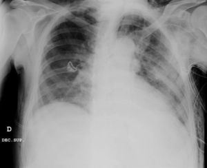 Bilateral pneumothorax and bilateral subcutaneous emphysema.