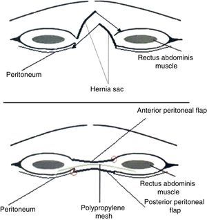 Diagram of retromuscular plasty. M: muscle.