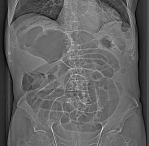 The presence of ectopic caecal dilation with small bowel loop dilation.