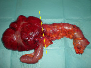 Surgical specimen of right colectomy with the theoretical site of the adhesion (yellow line) that caused the obstruction and caecal bascule.