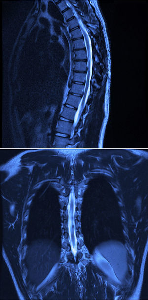 Post-operative magnetic resonance images of the thoracic spine in T2 sequence, showing the complete resection of the cyst, with no signs of compression or recurrence of the lesion. Sagittal slice, on the left, coronal slice on the right.