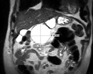 Computed axial tomography showing the mesenteric cyst; a clear demarcation plane can be observed between the cyst and the liver.