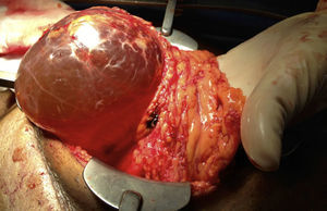 Image taken during surgery showing the cyst free from adhesions, prior to its resection.