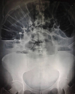 Simple abdominal plate showing signs suggestive of intestinal obstruction.