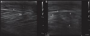 (A) Ultrasound image in 2D mode, longitudinal section of the left rectus femoris muscle of a healthy patient, showing muscle fascia (F) of preserved diameter and muscle fascicles (MF) distributed obliquely and evenly, characteristic image in “bundles of straw”. (B) Ultrasound image of the left rectus femoris muscle with rhabdomyolysis, showing muscle fascia thickening (F), loss of orientation of the muscle fascicles with reduction of echogenicity and anechoic areas (E).