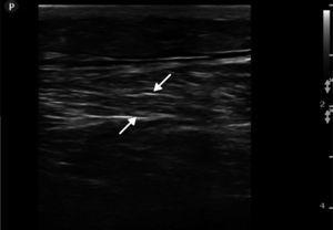 Ultrasound image in 2D of the left rectus femoris muscle showing hyperechoic intramuscular areas and disorganised distribution of the muscle fascicles (arrows).