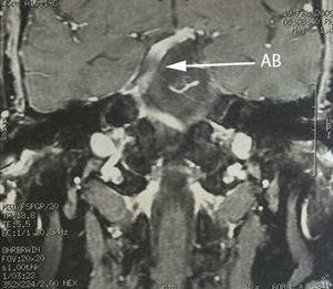 Coronal section of T1 contrast magnetic resonance imaging, showing dolichoectatic course of the basilar artery (BA) towards the right and in its ascent through the brainstem.