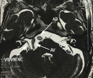Axial section of FIESTA magnetic resonance imaging showing compression and displacement of the vii-viii nerve complex (vii–viii CN) by the right vertebral artery (VA) before it joins the basilar artery (BA).