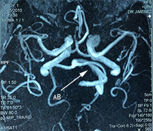 Vascular reconstruction by magnetic angioresonance, showing vertebrobasilar (BA) dolichoectasia towards the left.