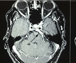Axial section of T1 contrast magnetic resonance imaging, showing compression and displacement of the trigeminal nerve by the vertebrobasilar complex (BA).