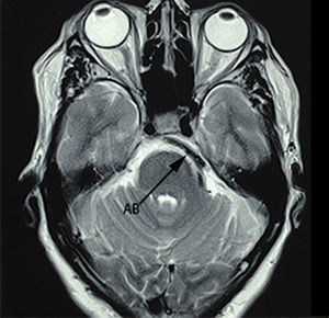 Axial section of T2 sequence magnetic resonance imaging, showing an absence of signal for the basilar artery (AB) with compression of the vii–viii nerve complex.