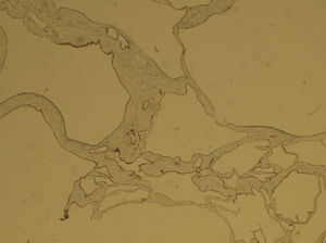 Inmunohistochemistry showing constant expression of calretinin throughout the lining of the cysts (calretinin 10×).