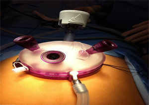 Gelpoint platform for single portal surgery.