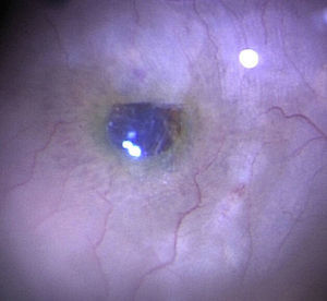 Packing the internal limiting membrane autograft inside the macular hole.