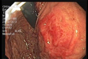 Endoscopic study showing pulsing extrinsic compression at the level of the third portion of the duodenum.