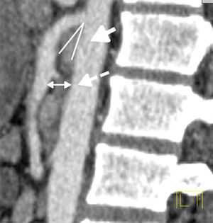 Computerised axial tomography with oral and arterial phase intravenous contrast showing the reduction in the angle of the upper mesenteric artery (continuous arrow) and the aortomesenteric distance (discontinuous arrow).