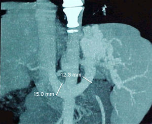 Spontaneous shunt from the right gastroepiploic vein to the infrarenal cava vein.