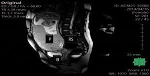 Nuclear magnetic resonance image. P: placenta; RS: recto sigmoid; B: bladder.