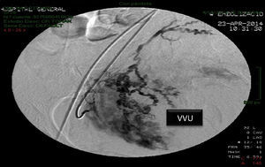 Selective embolisation of the right uterine artery. VVU: right bladder and uterine vascularisation.