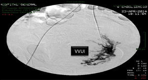 Embolisation of the left uterine artery. VVUI: left bladder and uterine vascularisation.