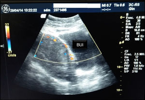 Doppler ultrasound scan. BUI: bladder and uterine interface.