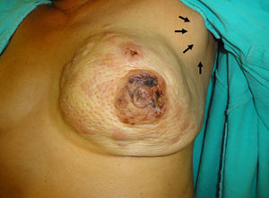 Clinical image of the left mammary gland clearly showing asymmetry due to tumour substitution with increase in volume in all 4 quadrants, cutaneous changes due to invasion, orange skin, skin metastasis, retraction of the areola-nipple with invasion of areas of ischaemia in the surface of the areola, while a ganglion conglomerate can be seen in the axilla (arrows).
