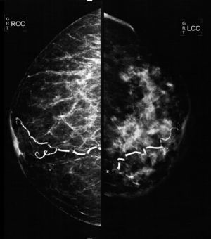 Cephalocaudal mammography showing diffuse thickening of the skin of the left mammary gland, a dense pattern that substitutes 80% of the breast tissue and extends irregularly to the pre- and retromammary fat layers. The vascular trajectories are partially calcified.
