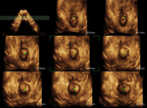 The arrow indicates a discontinuity in the external anal sphincter that corresponds to a sphincter lesion in the 6 central slices, established immediately after the birth.