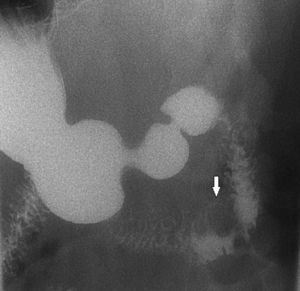 Esophagogastroduodenal transit: tumour in the second–third duodenal portion (arrowed), which reduces the calibre of the internal duodenum.