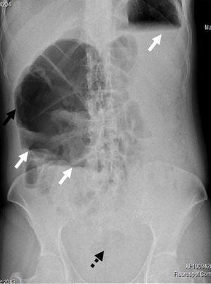 Simple standing X-ray of the abdomen with caecal dilation (black arrow), hydro-aereo levels (white arrows) and absence of air in the rectal ampule (discontinuous black arrow).