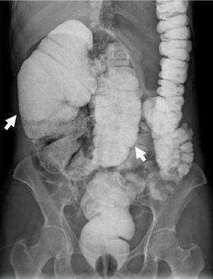 Colon with enema showing the coffee bean sign (white arrows).