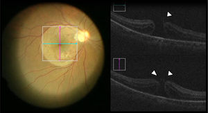 Transurgical optical coherence tomographic image, showing the persistence of internal limiting membrane on the edges of the macular hole (white arrows) as the end of limitorexis, so that the surgeon decided to complete its removal.