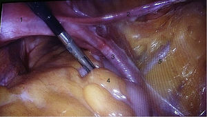 (1) Uterus, (2) round ligament, (3) pelvic infundibulum ligament, (4) rectum and (5) external iliac vessels.