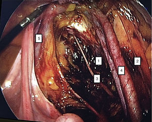 Limits of pelvic lymphadenectomy. (1) Obturator fossa, (2) genitocrural nerve, (3) obturator nerve, (4) iliac vessels, (5) urethra.