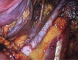Upper limit of lymphatic dissection (2cm above the iliac bifurcation).