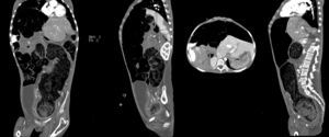 Computed axial tomography with double contrast. The diameter of the colon reaches 53mm and at the level of the sigmoid and rectum is 98mm in diameter.
