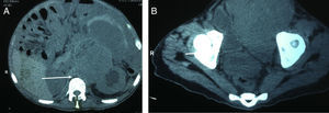 CAT scan of the abdomen and pelvis. (A) Paraaortic node conglomerate which displaces vascular structures leading to left pyelocaliceal ectasia. (B) Tumour node activity of the common iliac artery and left internal iliac artery leading to displacement of the bladder.