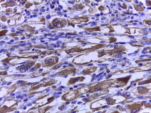 Immunohistochemistry. Positive desmin staining of spindle tumour cells (40×).