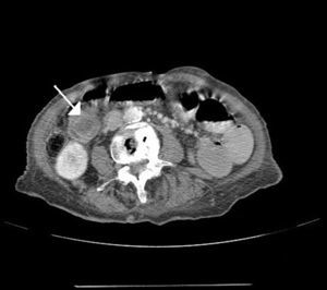 Doughnut image (arrow) in the ileum with change of right intestine at that level.