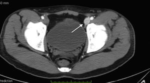 CT scan: axial section in the inguinal region, showing contrast in the artery at the iliac vein level, affected by the said fistula.