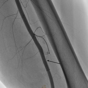 Posterior to stent implantation, contrast staining with no leak of contrast observed, fistular flow having been obliterated.