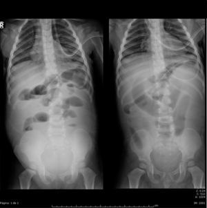 Simple abdominal X-ray, with dilated loops, air-fluid levels and an absence of gas in the rectal ampulla.