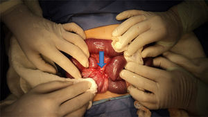 Anomalous congenital band compressing the ileum against the mesentery at 50cm from the ileocaecal valve.