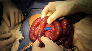 Site of compression by the anomalous congenital band once cut, with ischaemic changes in the intestine.